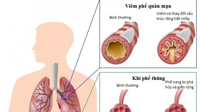 Lời khuyên đối với người bệnh mắc phổi tắc nghẽn mãn tính trong đại dịch Covid-19