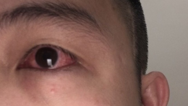 Đỏ mắt - di chứng Covid cần cẩn trọng