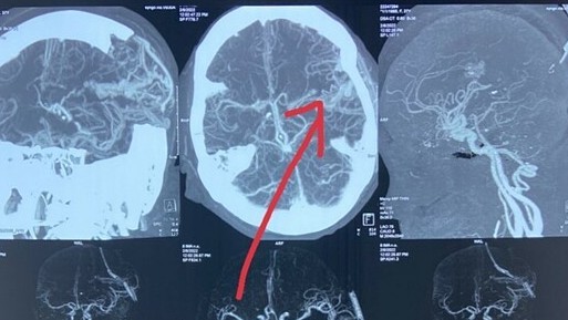 Đột quỵ tuổi 30 do dị dạng mạch máu não