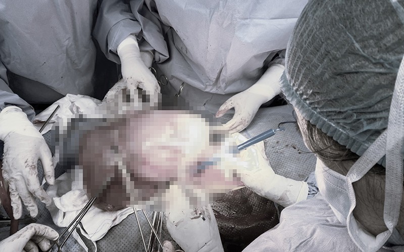 70-80% phụ nữ từ 50 tuổi trở lên có u xơ tử cung