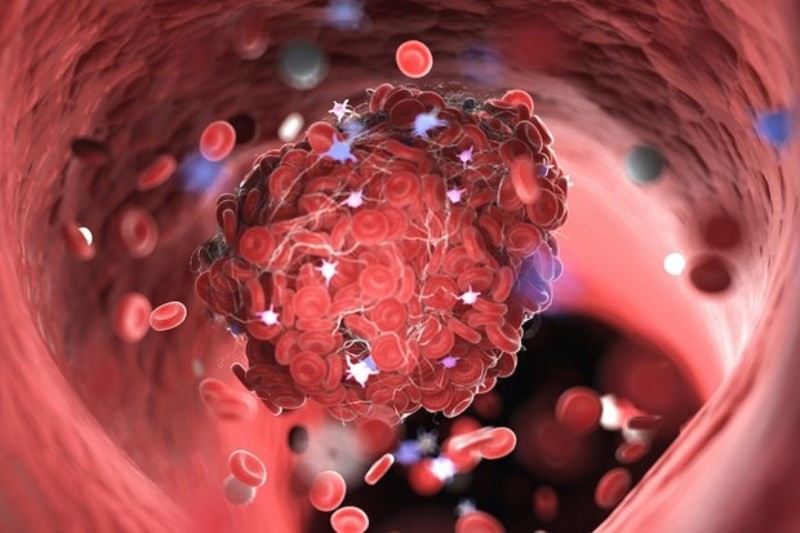 Người mắc Covid-19 có nguy cơ cao hình thành cục máu đông trong phổi