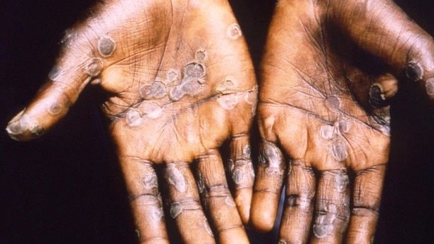 Các triệu chứng để xác định mắc bệnh đậu mùa khỉ là gì?