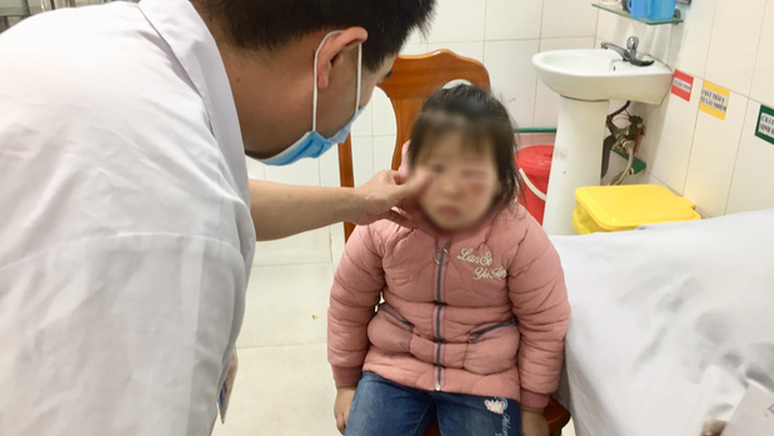 Người nhà dùng lá trầu không rửa mắt, bé 6 tuổi phải nhập viện