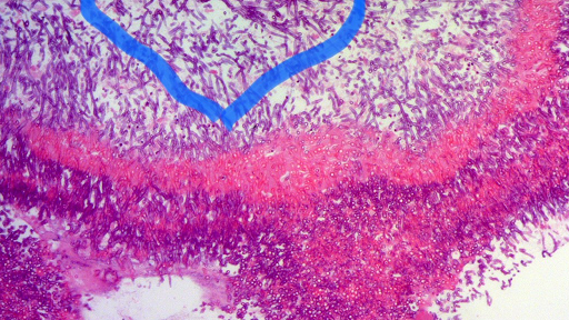 Tử vong vì nhiễm nấm Aspergillus fumigatus sau khi ăn mối