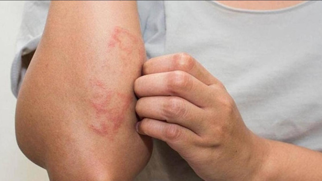 Làm gì tránh nứt nẻ, ngứa ngáy mùa hanh khô?