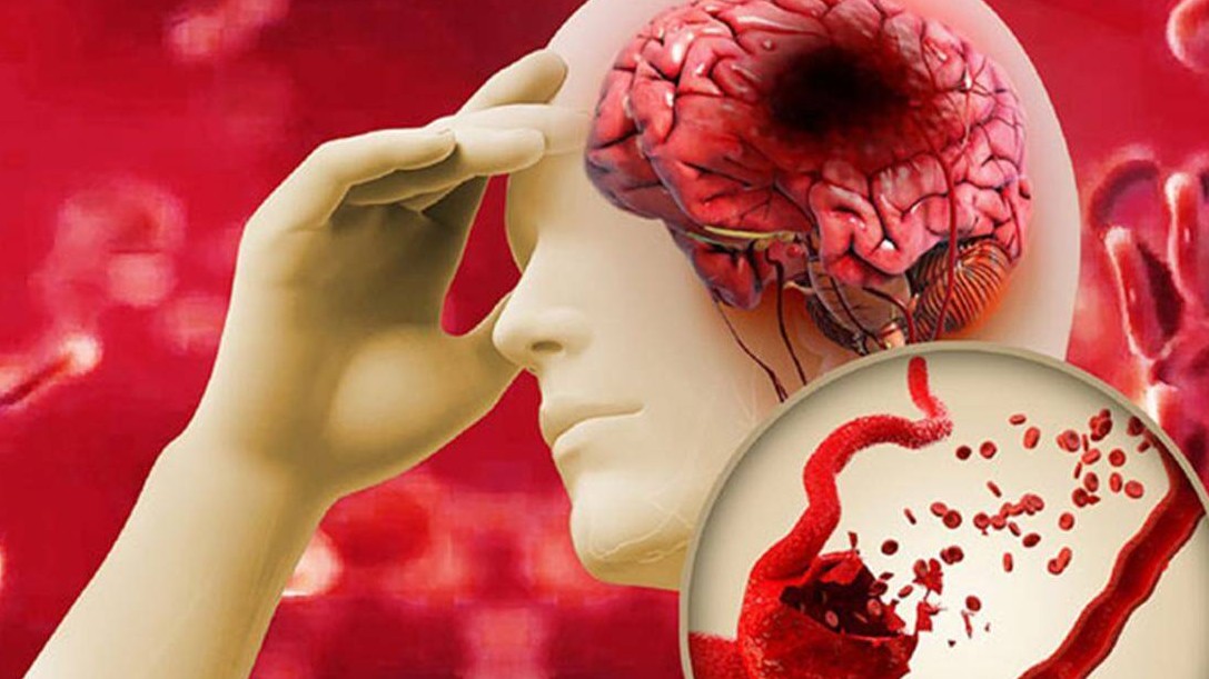 Lưu ý 3 dấu hiệu nhận diện đột quỵ