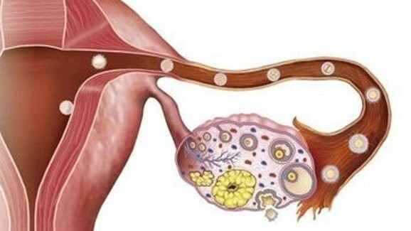 Dấu hiệu nào nhận diện ung thư buồng trứng?