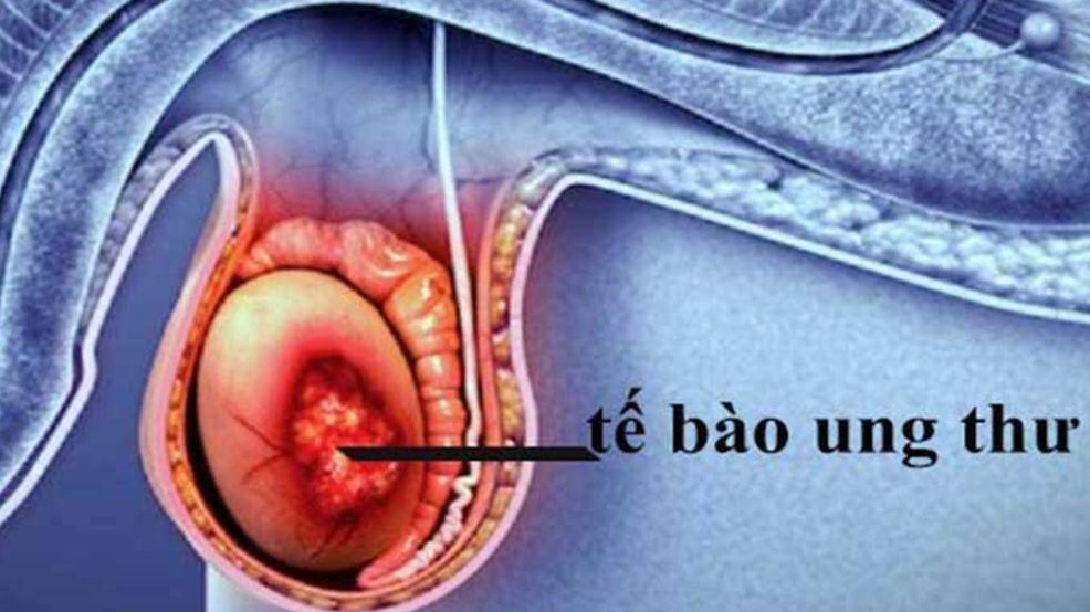 Dấu hiệu nào cảnh báo ung thư tinh hoàn?