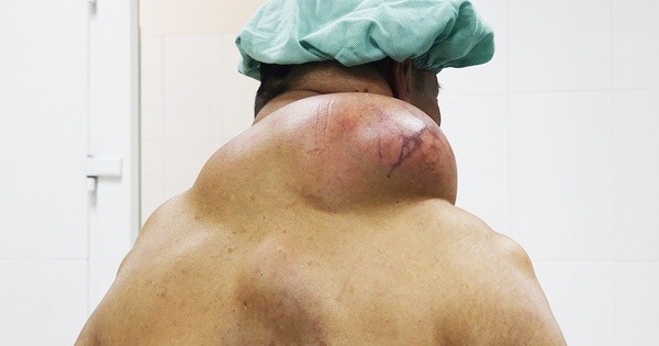 Khối u mỡ khủng gây biến dạng vùng gáy của người đàn ông nghiện rượu nhiều năm.