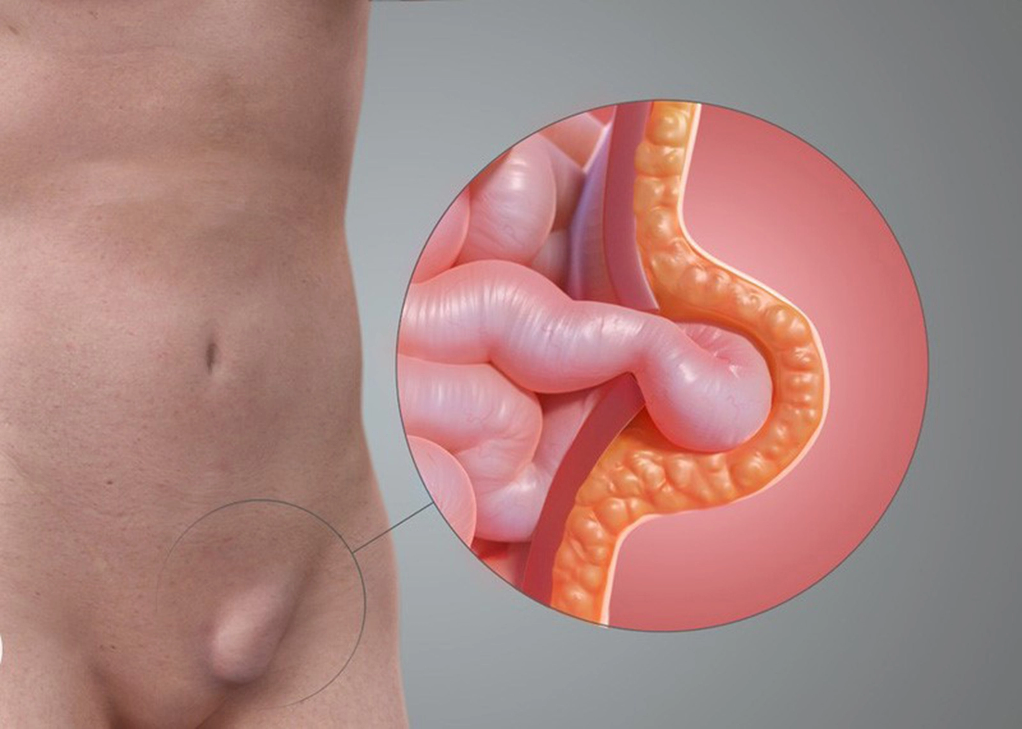 Thoát vị bẹn ở người lớn tuổi có nguy hiểm?