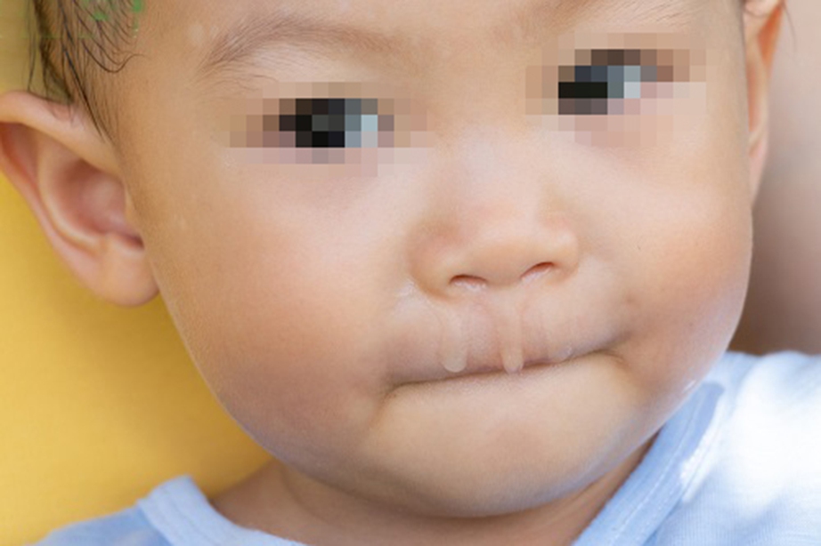 Trẻ thò lò mũi xanh, xử trí thế nào?