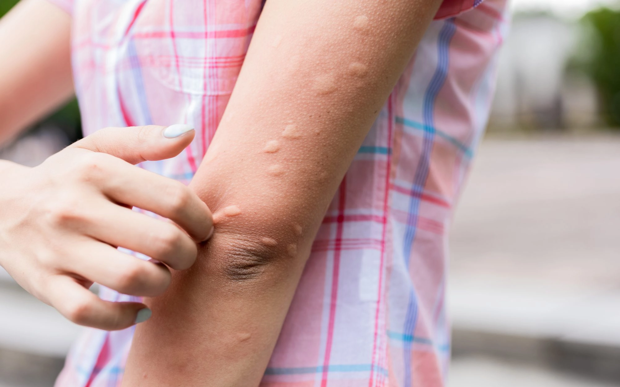 Nổi mày đay có phải do suy giảm chức năng gan?