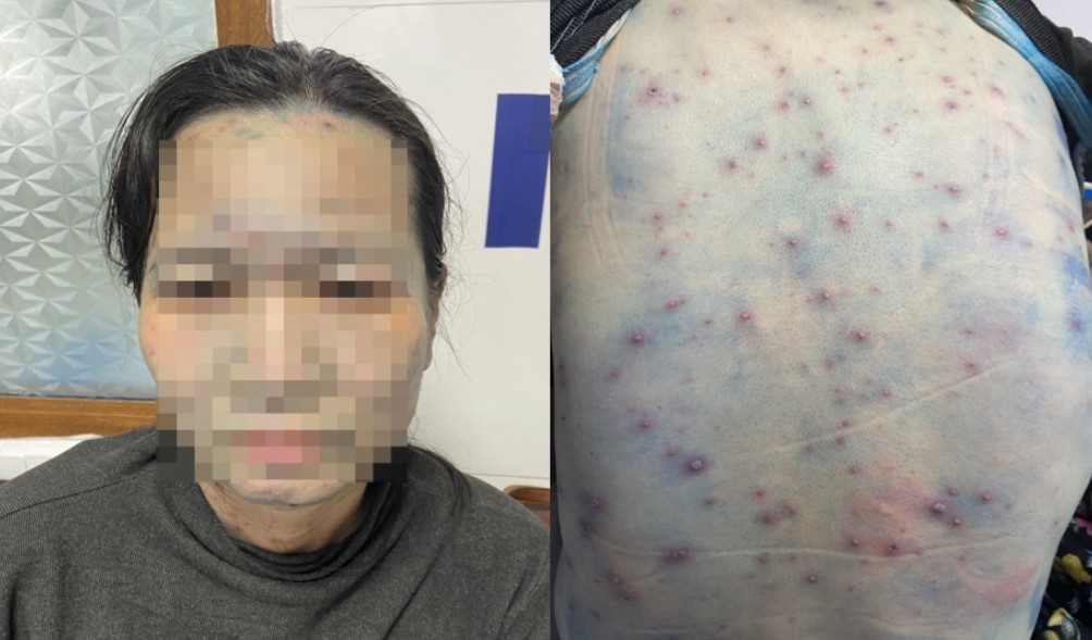 Lây nhiễm thủy đậu, nhiều bệnh nhân đái tháo đường trở nặng