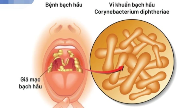 Cần lưu ý điểm gì khi trẻ mắc bệnh bạch hầu