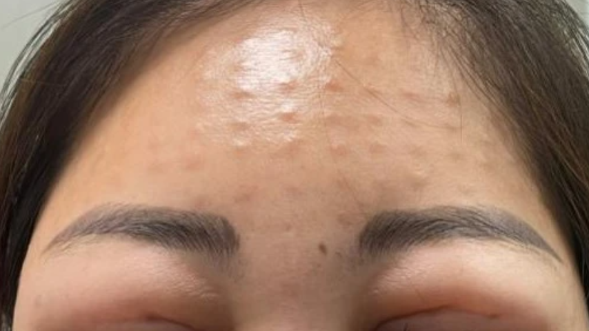 Biến chứng vì tiêm meso trẻ hóa ở cơ sở không uy tín